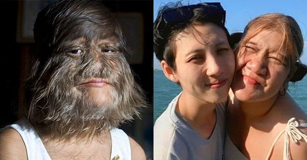 You are currently viewing Cô gái nhiều lông nhất thế giới tìm được tình mới sau đổ vỡ hôn nhân