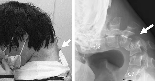 You are currently viewing Hình ảnh cổ vẹo vọ đáng sợ của nam thanh niên vì sở thích quen thuộc