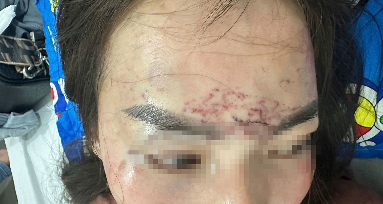 You are currently viewing Khởi tố vụ người phụ nữ đi đường bất ngờ bị kéo lên ô tô, ‘tra tấn’ bằng axit