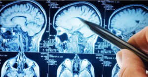 Read more about the article Người phụ nữ phát hiện ung thư não giai đoạn cuối từ dấu hiệu kỳ lạ của mũi