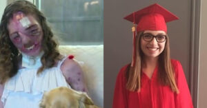 Read more about the article Cô gái phục hồi kỳ diệu sau khi bị chó dữ cắn xé 800 vết