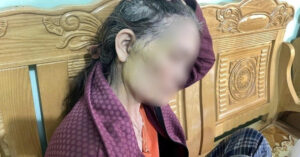 Read more about the article Người phụ nữ 64 tuổi đi thẩm mỹ căng da mặt gặp biến chứng nghiêm trọng