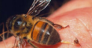 Read more about the article Người phụ nữ trốn khỏi bệnh viện, mua ong đốt vào ngực chữa ung thư